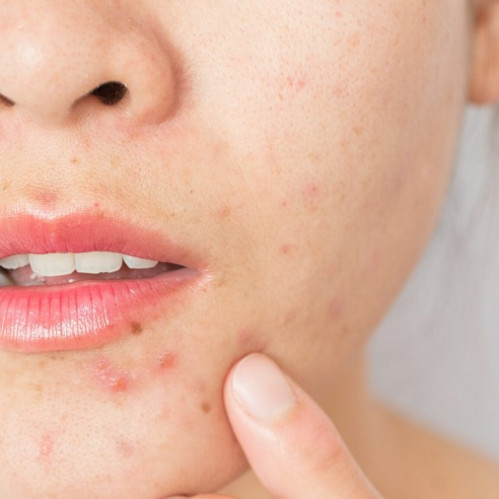 Teridagi yiring: nima uchun yallig'lanish paydo bo'ladi va u bilan qanday kurashish kerak