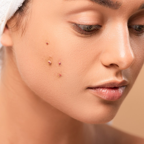 Мази от прыщей. Средства от акне, черных точек и других проблем кожи