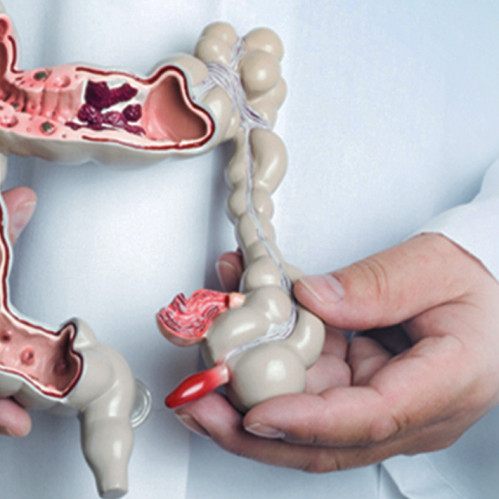 Gemorroy: sabablari, belgilari va samarali davolash.