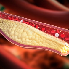 Giperkolesterolemiyada yurakni parvarish qilish: qon tomirlarini qanday sog'lom saqlash kerak?