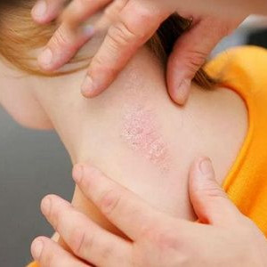 Psoriaz: sabablari, belgilari va samarali kurash usullari