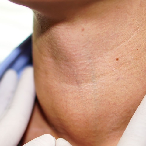 Guatr: sabablari, belgilari va samarali davolash usullari