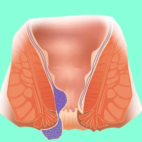 Средства от геморроя. Виды препаратов, восстанавливающих ткани прямой кишки