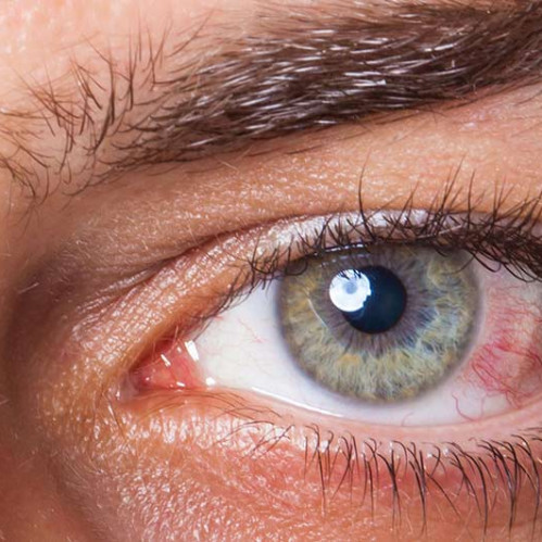 Ko'z ichi bosimining buzilishini tashxislash va oldini olish