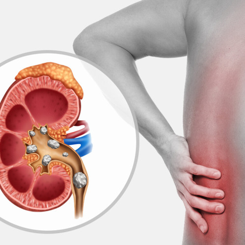 Urolitiaz: buyrak toshlari va ularni yo'q qilishning samarali usullari