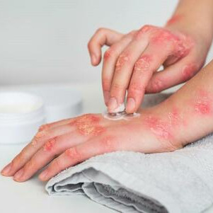 Покраснение, зуд, боль? Узнай, как предотвратить инфекции кожи и слизистых