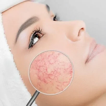 Rosacea: sabablari, belgilari va kurashish usullari