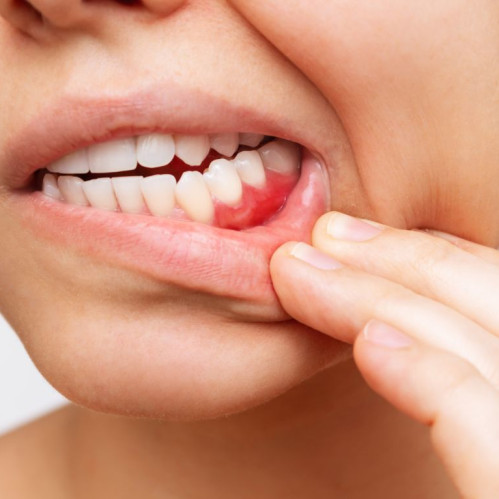 Stomatit uchun dorilar. Stomatitning birinchi alomatlariga yordam beradigan malhamlar, jellar, spreylar va tabletkalar