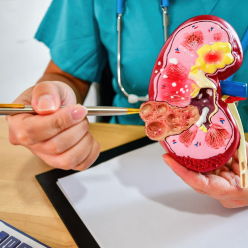 Pielonefritni qanday engish mumkin: dorilar, maslahatlar, oldini olish