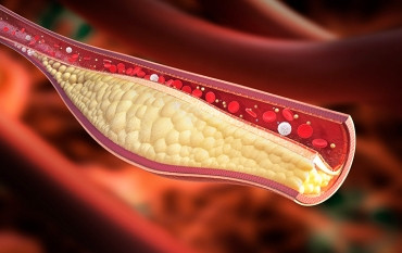 Забота о сердце при гиперхолестеринемии: как сохранить здоровье сосудов?