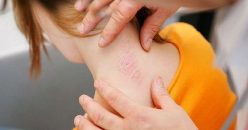 Псориаз: причины, симптомы и эффективные способы борьбы