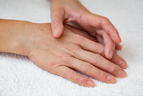 Tafsilotlar maqola: ekzemani qanday davolash mumkin? Teri kasalliklari uchun eng yaxshi dorilar