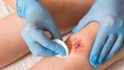 Yiringli yaralar: davolash va oldini olishning zamonaviy usullari