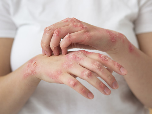 Зачем принимать этот препарат при грибковых инфекциях?