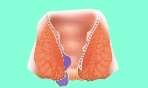 Средства от геморроя. Виды препаратов, восстанавливающих ткани прямой кишки