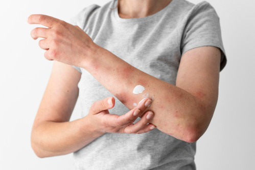 Dermatitga qarshi teri kremi: nozik parvarish va tiklanish