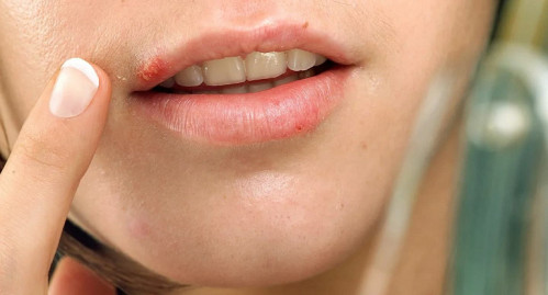 Таблетки от герпеса. Основные виды препаратов для лечения вируса, поражающего слизистые оболочки