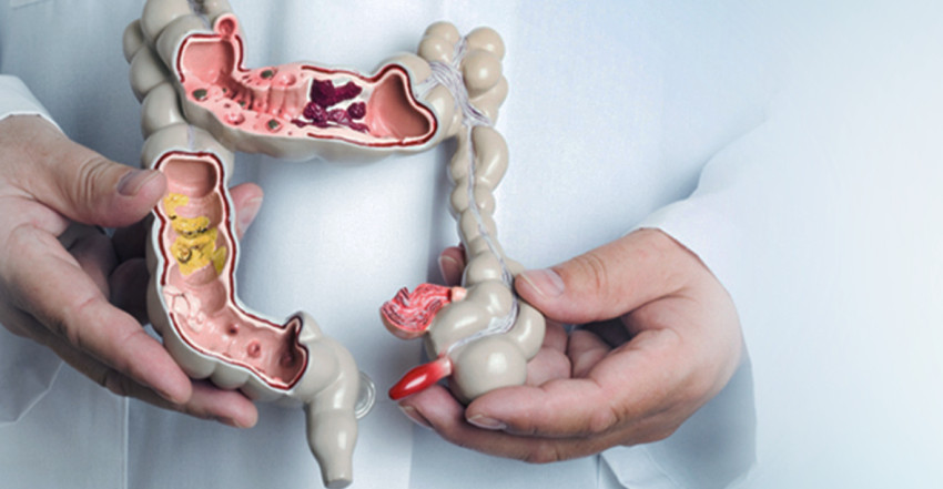 Gemorroy: sabablari, belgilari va samarali davolash.