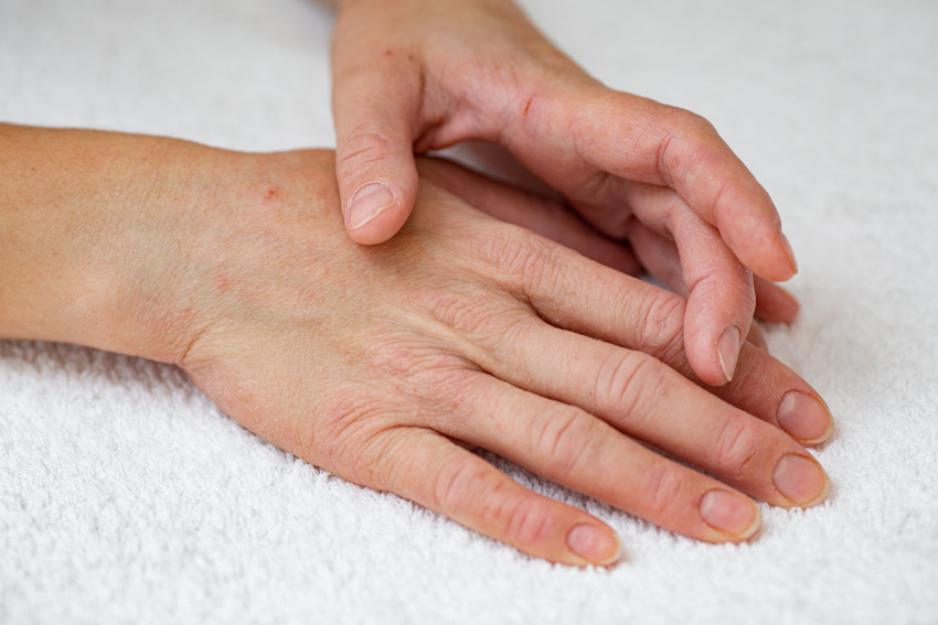 Чем лечить экзему? Лучшие препараты от заболевания кожи