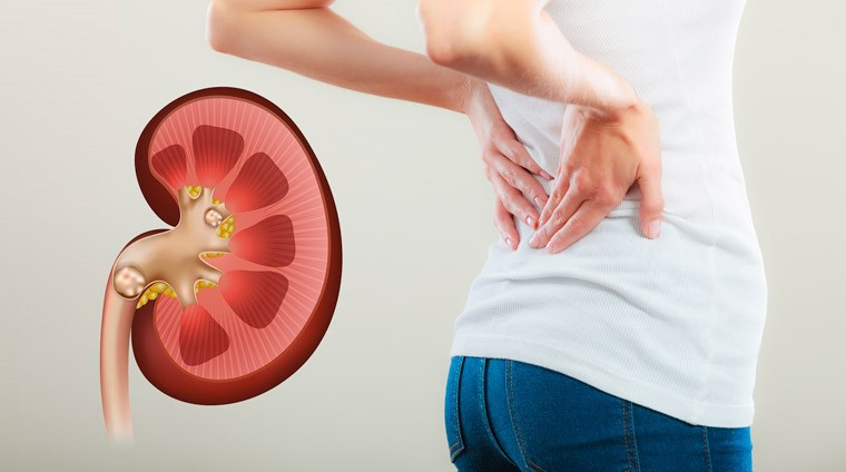 Urolitiaz: buyrak toshlari va ularni yo'q qilishning samarali usullari