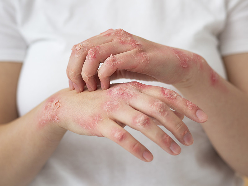 Nima uchun bu preparatni qo'ziqorin infektsiyalari uchun qabul qilish kerak?