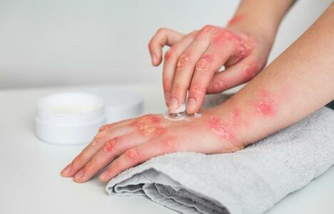 Покраснение, зуд, боль? Узнай, как предотвратить инфекции кожи и слизистых