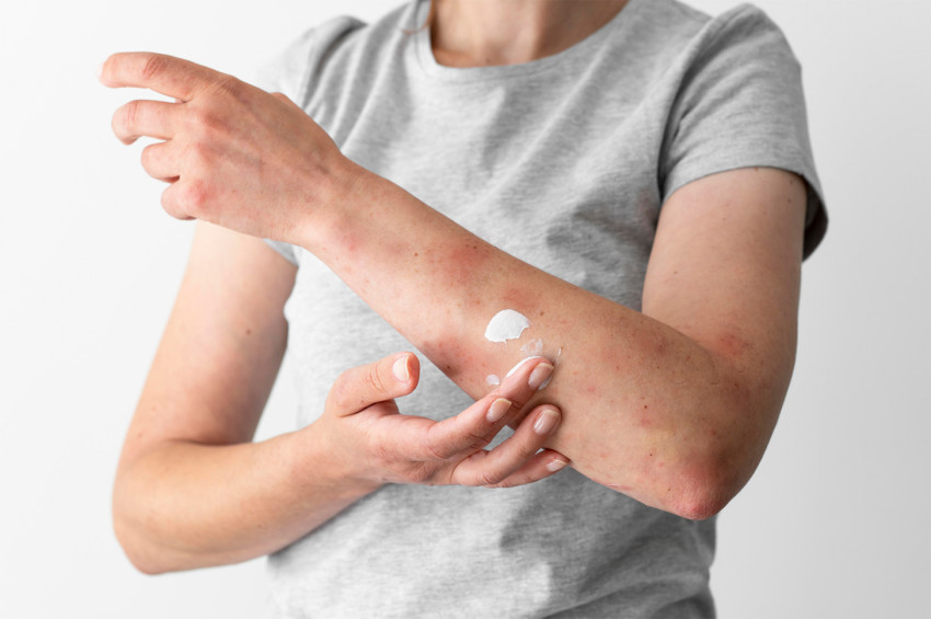 Dermatitga qarshi teri kremi: nozik parvarish va tiklanish